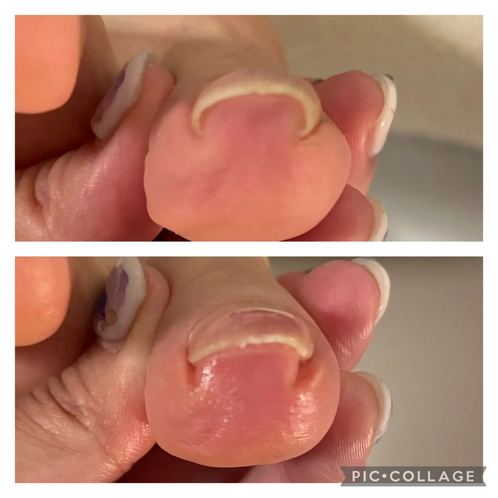 巻き爪矯正(B/S)
[爪カット]